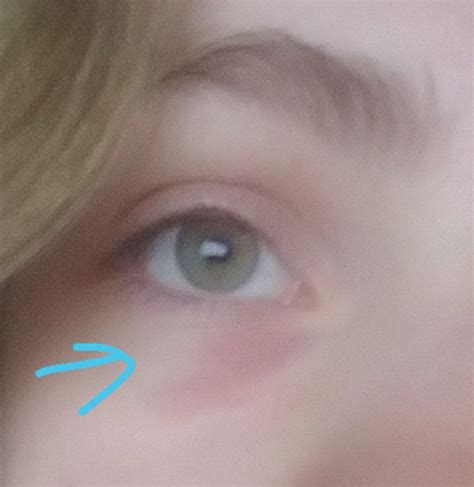Skin Concerns I Have This Red Itchy Patch Under My Eye I Normally