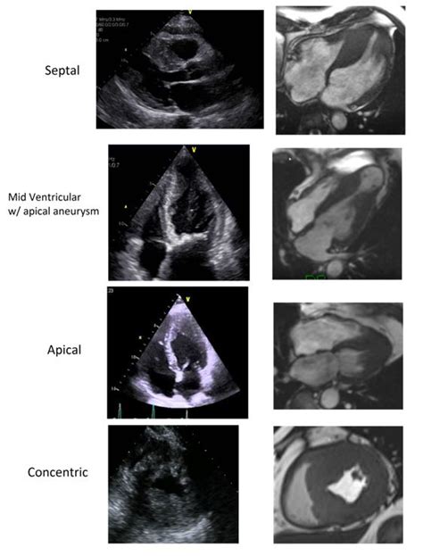 Imaging In Hypertrophic Cardiomyopathy American College Of Cardiology