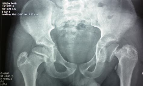 Femoral Neck Fractures Trauma Orthobullets 43680 The Best Porn Website