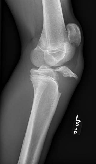So far, only ten simultaneous neugebauer, a., muensterer, o.j., buehligen, u. Tibial Tubercle Anatomy - Human Body Anatomy