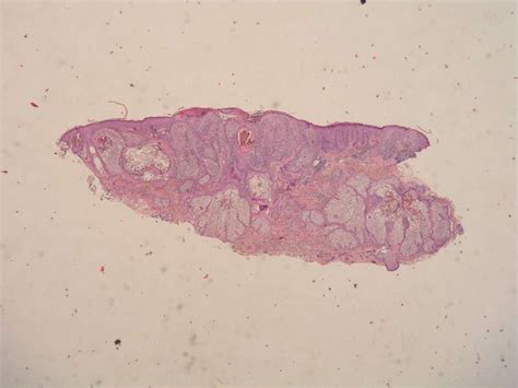 Microcystic Adnexal Carcinoma Bosnianpathology