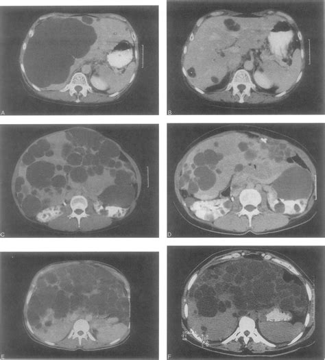 Polycystic liver disease also is manifest in the rare autosomal dominant polycystic liver disease (adpld) that is caused by a mutation in the gene on chromosome 19 that encodes for the protein. Suggested classification of patients with adult polycystic ...