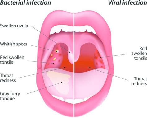 Can You Get Strep Throat Without Tonsils Strep Throat Bacterial