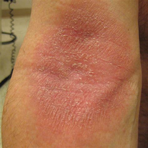 Psoriatic Arthritis Rash Images Symptoms And Treatment Goodrx
