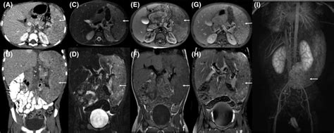 Ct And Mri Findings Of Splenomegaly Axial A And Coronal B Contrast