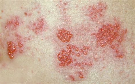 Herpes Zoster Rash Stock Image M2600349 Science Photo Library