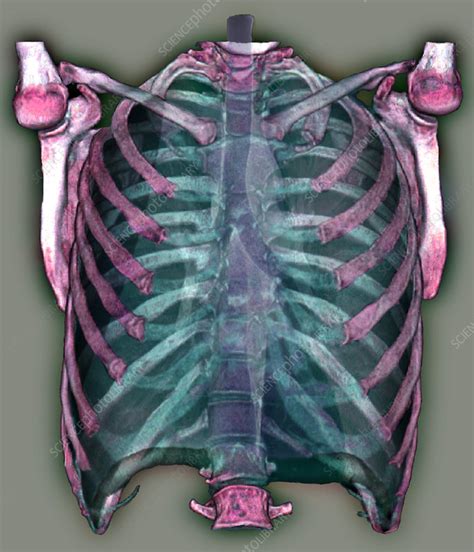 They may also be necessary to better evaluate underlying lung pathology. Pneumothorax, 3D CT scan - Stock Image - M240/0621 ...