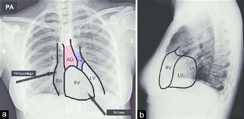 Normal Chest Pa And Lat Radiographic Views Chest X Ray A