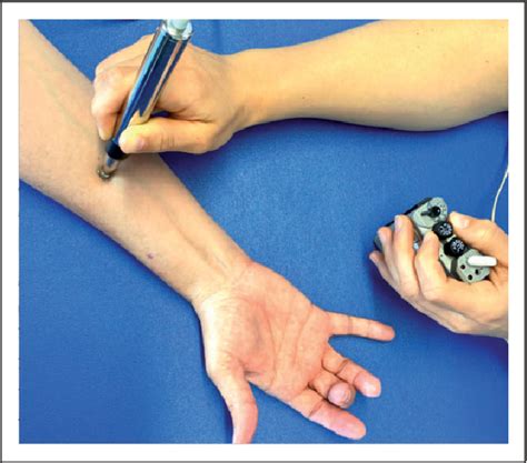 Figure 1 From Improving Hand Function After Spinal Cord Injury