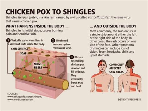 what you need to know about shingles infections