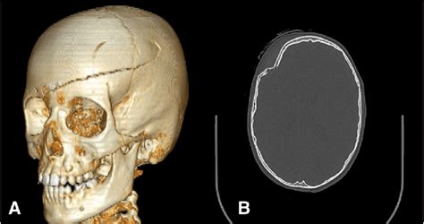 A Linear Skull Fracture A And A Depressed Skull Fracture B Which