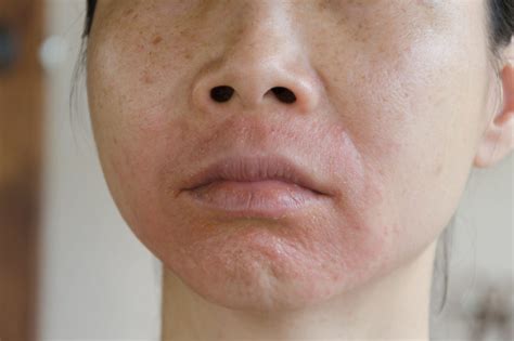 Before he can go out to find and. Psoriasis im Gesicht: Schmerzhaft und besonders belastend