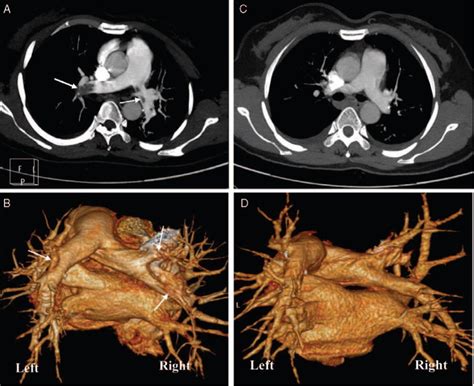 Ct Pulmonary Angiography Ctpa In Case 1 Ctpa With 2 Dimensional