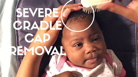 Newborn Cradle Cap Removal Rash All Over Youtube