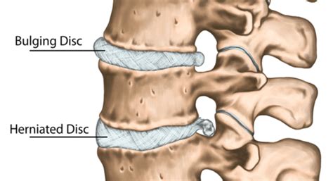 disc bulge and herniation cervical spine themovementmill