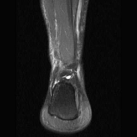 In ankle injuries, fibula fracture is also seen with ligamentous injuries. Stress fracture of fibula | Image | Radiopaedia.org