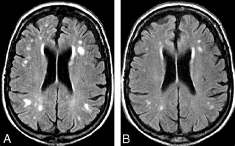 Decrease In The Volume Of White Matter Lesions With Improvement Of