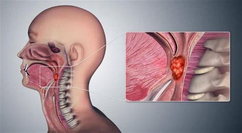 Throat Cancer Symptoms Causes In Men And Women Yeyelife