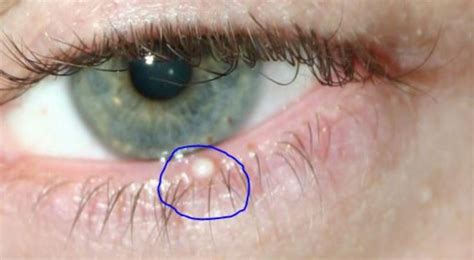 An Eyelid Pimple Stye Milia Chalazion Or Whitehead Skincarederm 2023