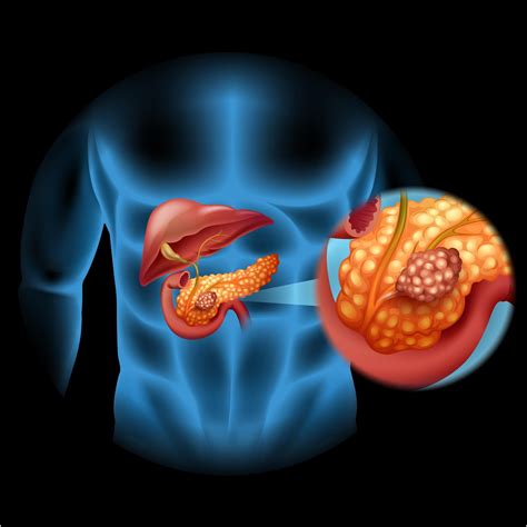 Why pancreatic cancer is so deadly | Houston Style Magazine | Urban ...
