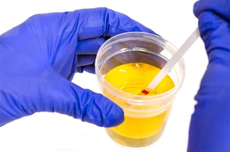 What Does A Urinalysis Test For Oxford Urgent Care