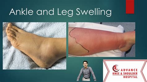 Top Causes Of Ankle And Leg Swelling Youtube