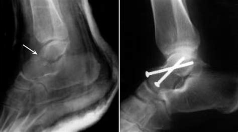 Talus Fractures Orthoinfo Aaos