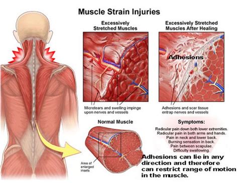 Muscle Adhesions Muscle Strain Muscle Adhesions Deep Tissue Massage