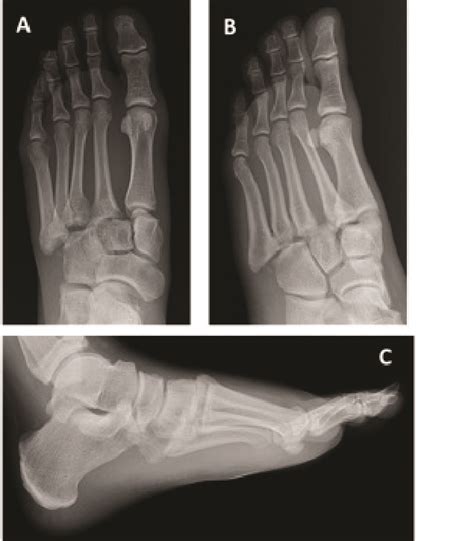 Lisfranc Fractures Injuries Dislocations Sprains Foot