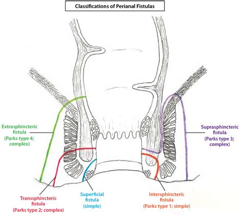 Perianal Fistula Causes Symptoms Diagnosis Treatment Surgery