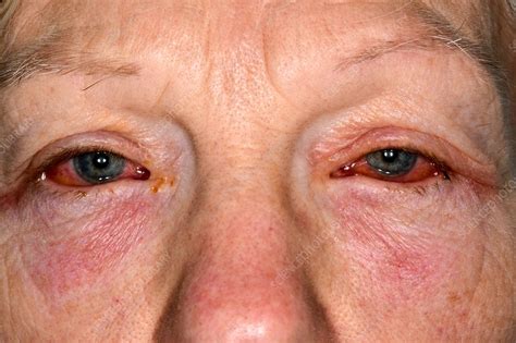 Viral Conjunctivitis Stock Image C0426380 Science Photo Library