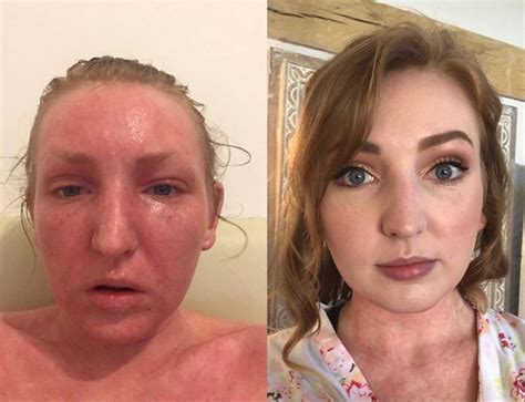 Womans Hell As Addiction To Eczema Steroid Cream Leaves Her