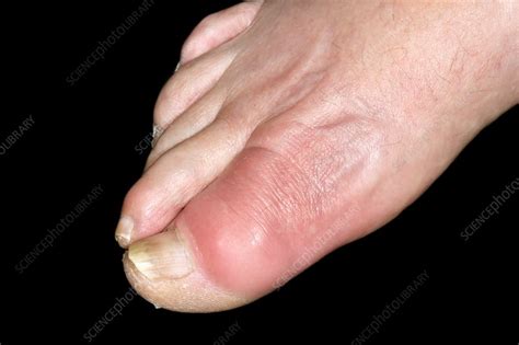 Gout Of The Big Toe Stock Image C0370906 Science Photo Library