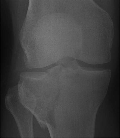 Schatzker Classification Of Tibial Plateau Fractures Use Of Ct And Mr
