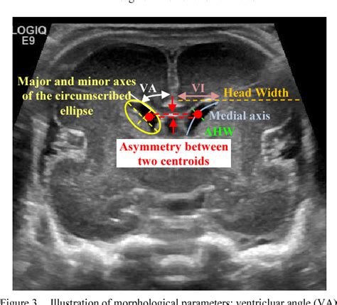 Cranial Ultrasound Based Prediction Of Post Hemorrhagic Hydrocephalus