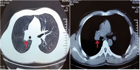 Mediastinal Tuberculous Lymphadenitis Presenting With Insidious Back