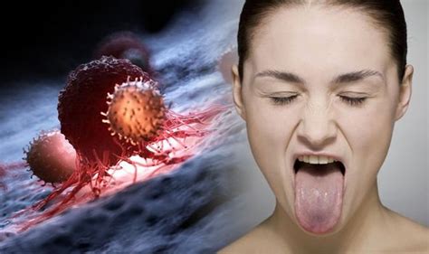 Mouth Cancer Symptoms Red Or White Patches On The Tongue Could Be A
