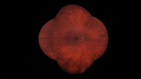 See More For Less With The Ultra Widefield Retinal Imager From