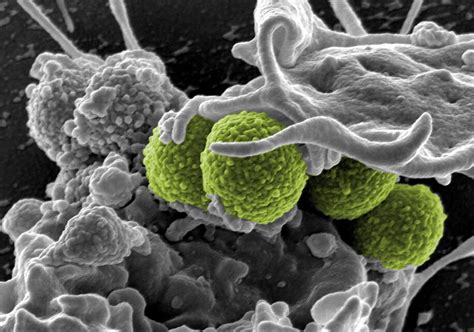 Mrsa Superbug Killed By 1100 Year Old Home Remedy Researchers Say