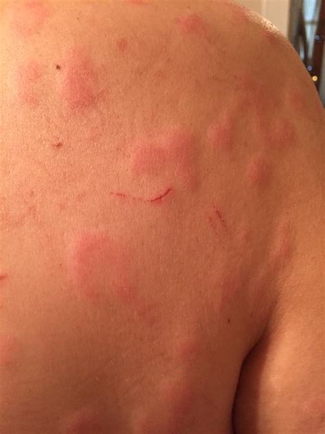 I Just Have To Accept People Will Be Looking At My Hives