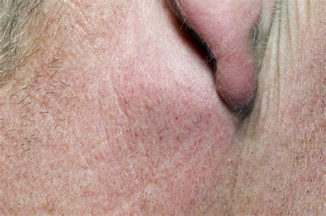Sebaceous Cyst Behind The Ear Stock Image C0169251 Science Photo