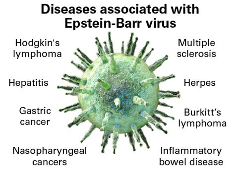 When Epstein Barr Virus Becomes A Chronic Menace Chronic Active Ebv