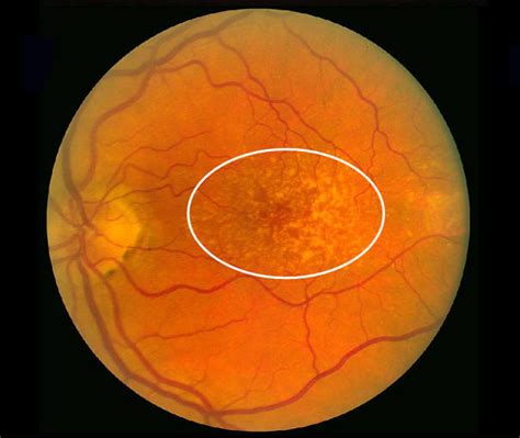 Figure 4 Color Fundus Photograph From An Webvision Ncbi