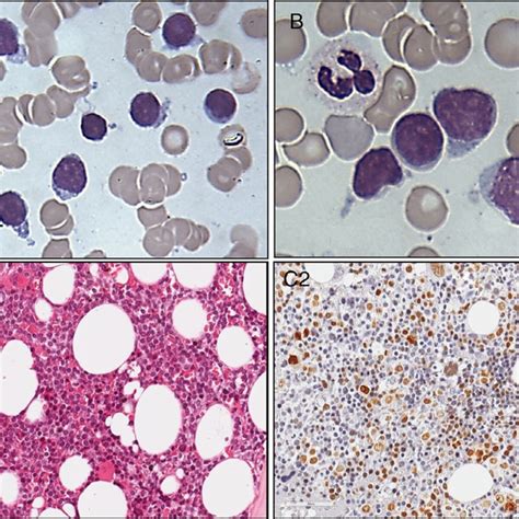Neoplastic Cell Morphology In Peripheral Blood A And Bone Marrow