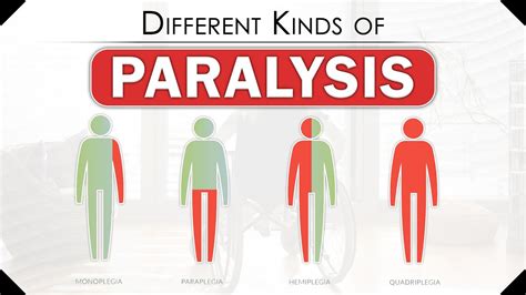 Different Kinds Of Paralysis How Does Someone Become Paralyzed