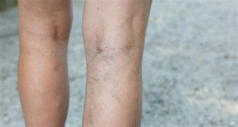 Spider Veins Vs Varicose Veins Differences Causes And Prevention