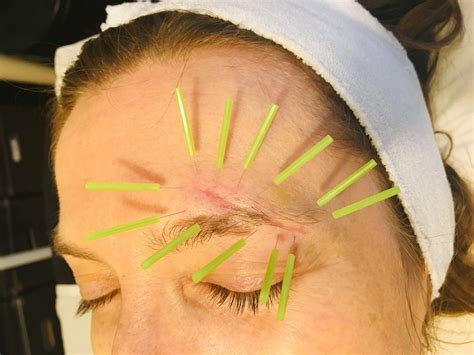 What I Learnt The Hard Way About Facial Scar Treatment Magnificent