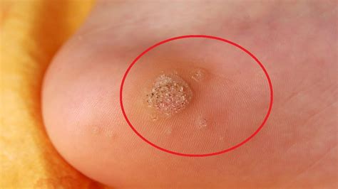 How To Get Rid Of Plantar Warts With Compound W Fast Youtube