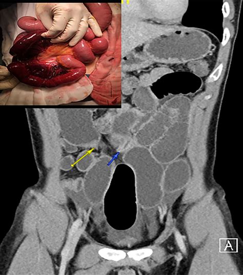 Adhesive Small Bowel Obstruction An Update Tong 2020 Acute Medicine And Surgery Wiley