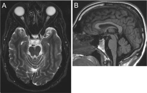 Brain MRI Images Atrophy Of The Optic Nerves And Optic Chiasm A